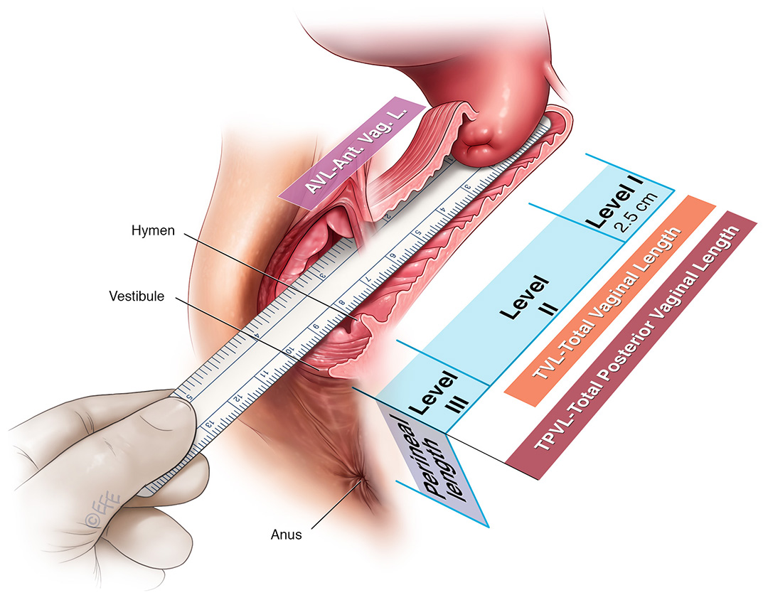 ICS 2018 Abstract #547 Vaginal lengths: how do they vary significantly?