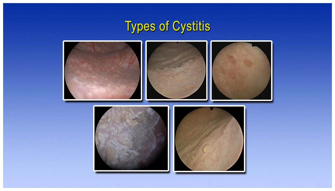 chronic cystitis)
