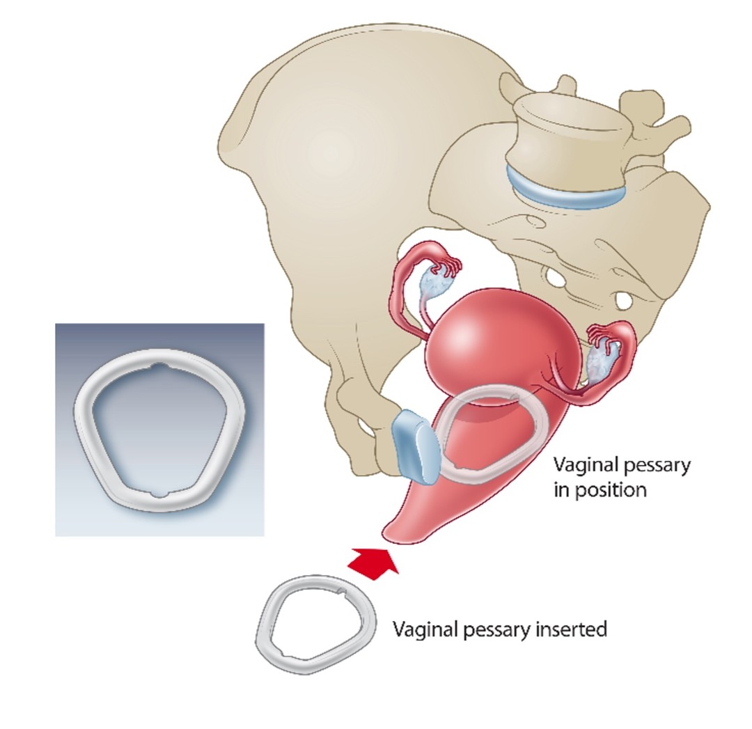 Pessary Fitting Kit Set, Size 2 - 7 | Miltex 30-FS1000 | Vitality Medical