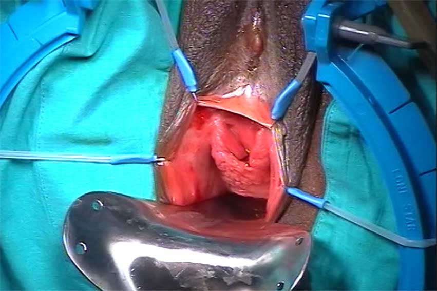 ICS Vesicovaginal Fistula Case Study 