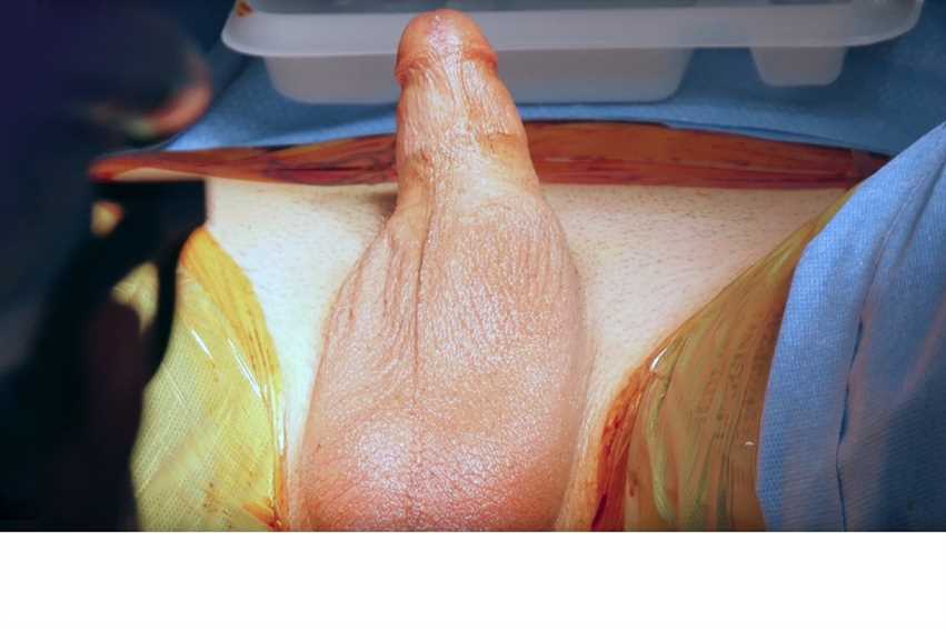 Post Op Vaginoplasty Post Op Vaginoplasty
